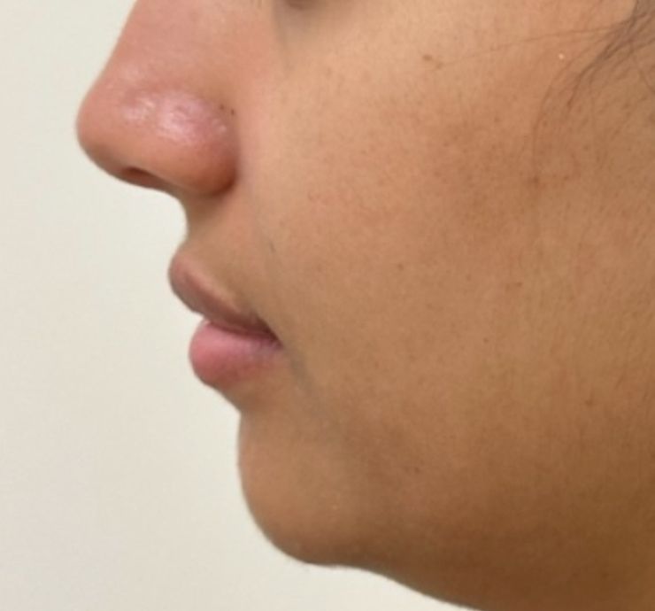 Lip Filler Before & After