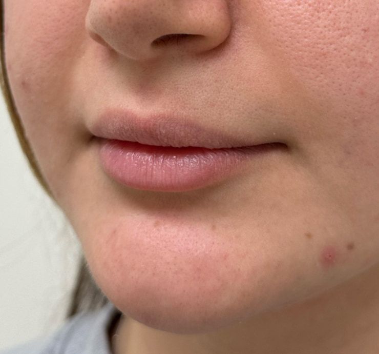 Lip Filler Before & After