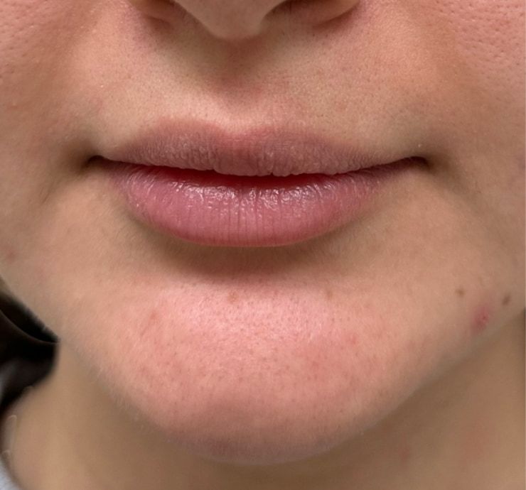 Lip Filler Before & After
