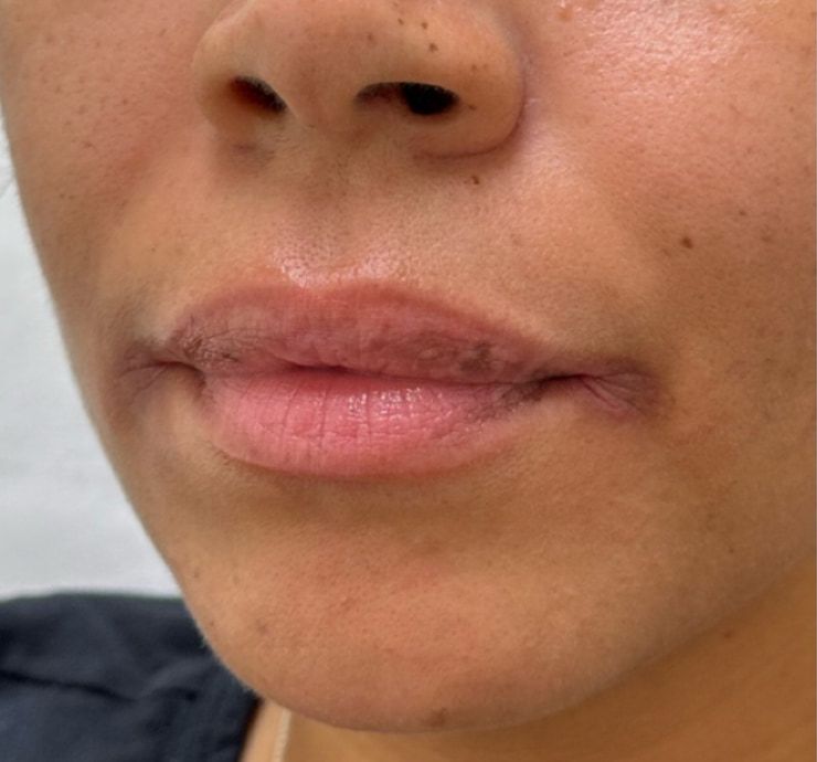 Lip Filler Before & After