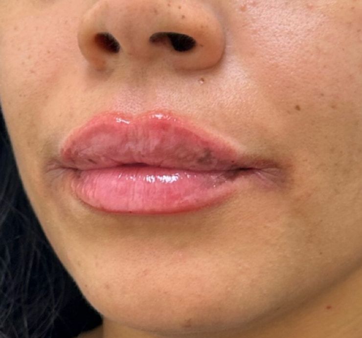 Lip Filler Before & After