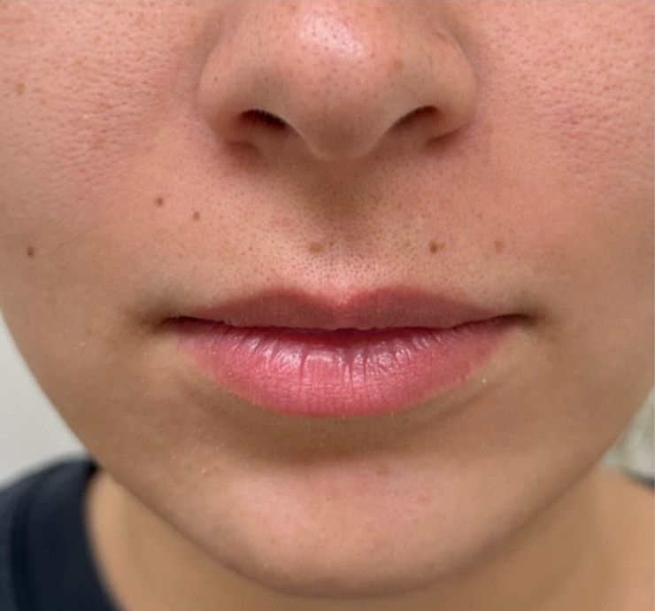Lip Filler Before & After