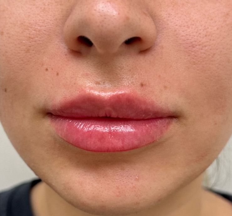 Lip Filler Before & After