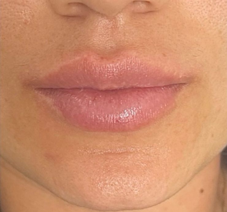Lip Filler Before & After