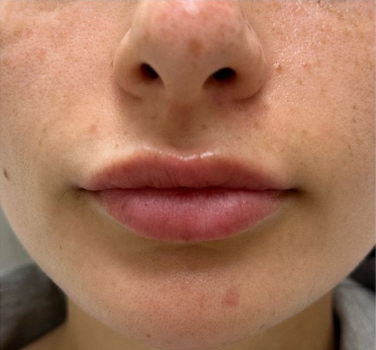Lip Filler Before & After