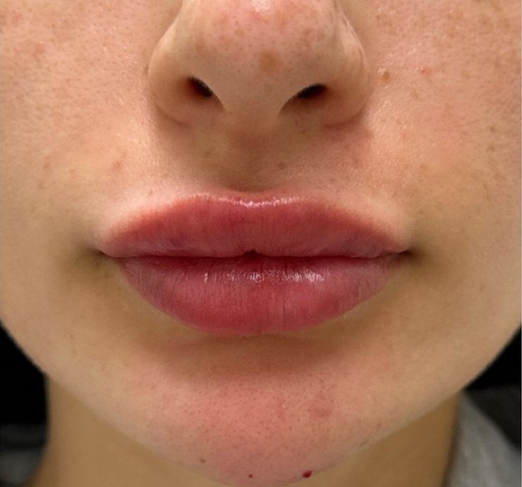 Lip Filler Before & After
