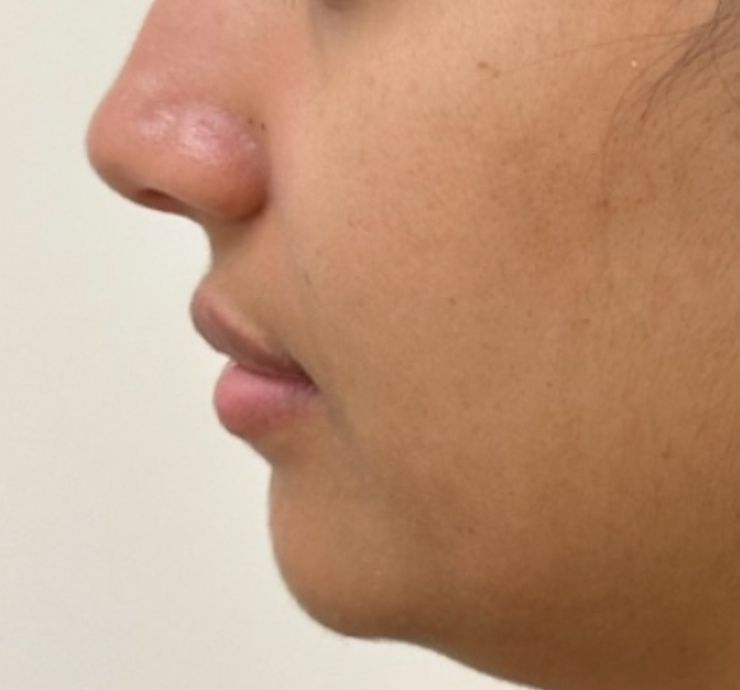 Morpheus8 Before & After