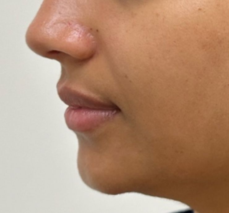 Morpheus8 Before & After